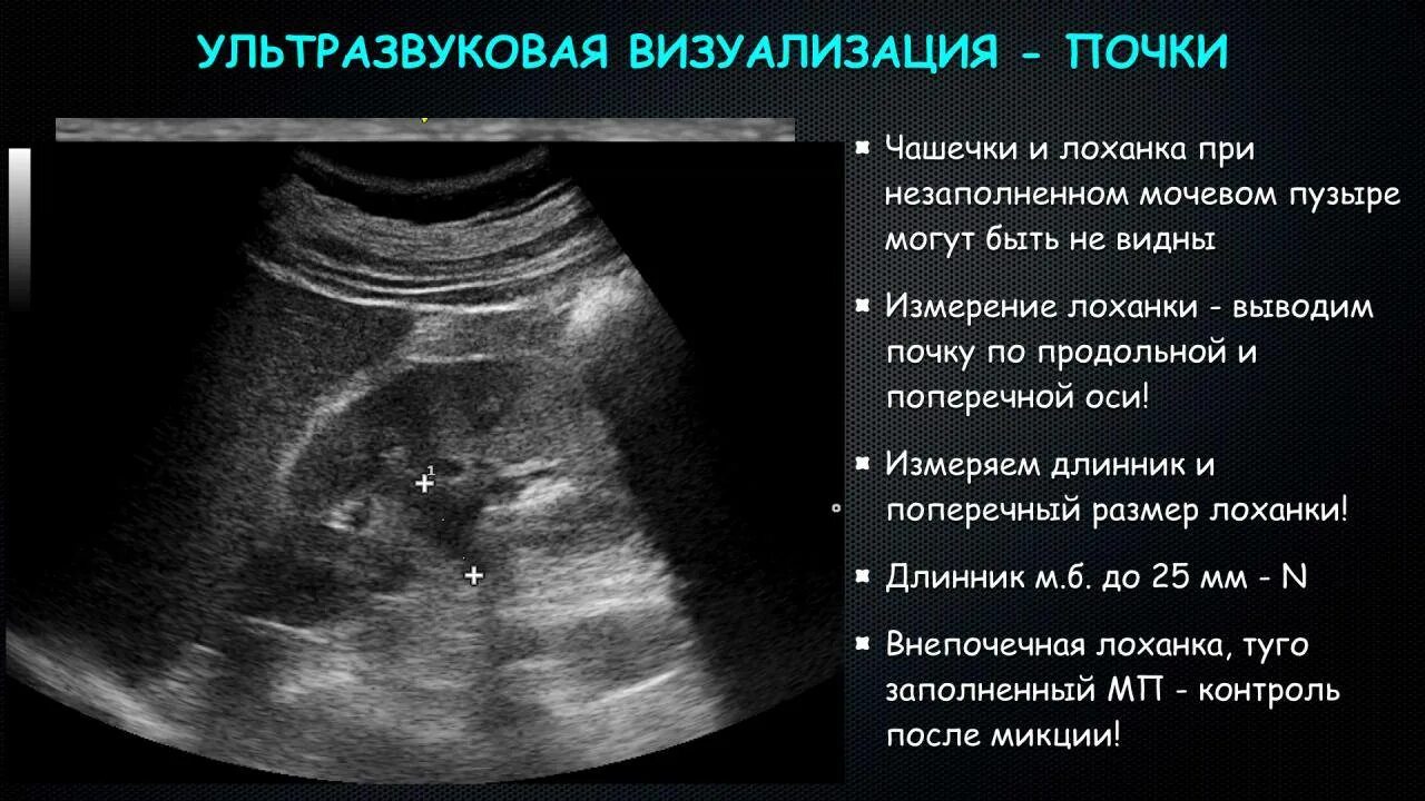 Узи лоханки почки. Внепочечная лоханка на УЗИ. Расширение лоханки почки на УЗИ. Расширение чашечек почки на УЗИ. Чашечки почки на УЗИ.