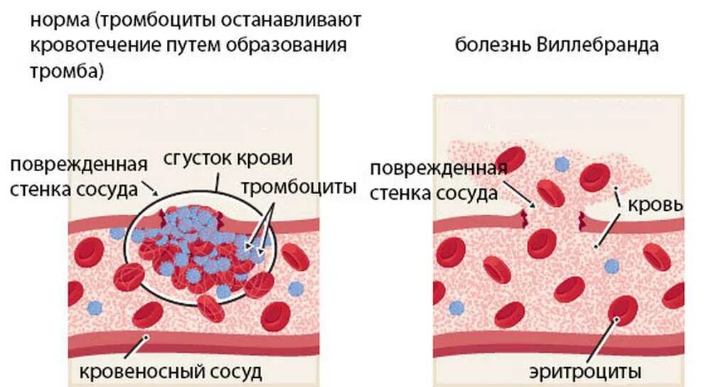 При повреждении сосудов тромбоциты. Основные клинические проявления болезни Виллебранда. Механизм развития болезни Виллебранда схема. Болезнь фон Виллебранда.