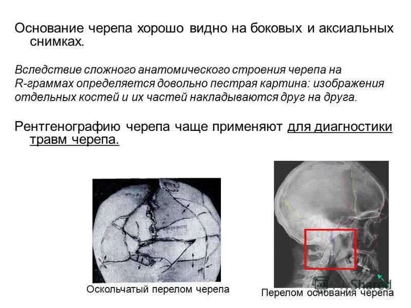 Кт головы с переломом височной кости. Оскольчатый перелом черепа. Многооскольчатый перелом черепа перелом костей черепа. Вдавленный перелом теменной кости кт. Оскольчатый перелом основания черепа.