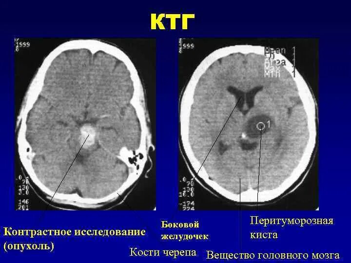 Киста бокового желудочка головного мозга. Опухоли боковых желудочков головного мозга.