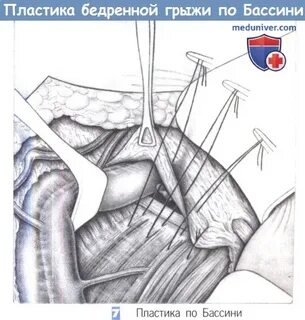Операция на грыжу сколько восстановление
