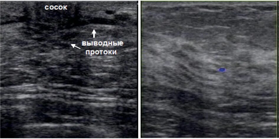 узи молочных желез железистая ткань. ультразвуковое исследование (узи) молочных желез. железистая ткань молочной железы на узи. типы строения молочной железы узи. узи молочных желез рязань.