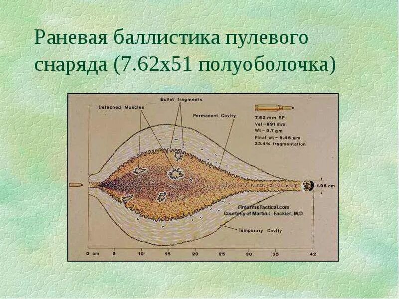 Пулевой канал. Раневая баллистика. раневой канал при огнестрельном. зоны поражения при огнестрельной ране. огнестрельное сквозное пулевое ранение.