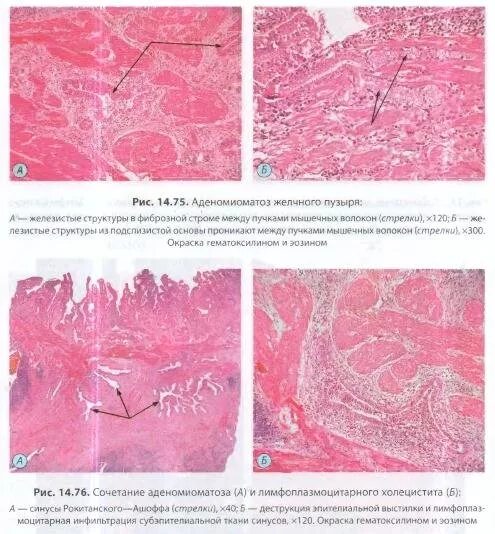 аденомиоматоз желчного пузыря что это такое