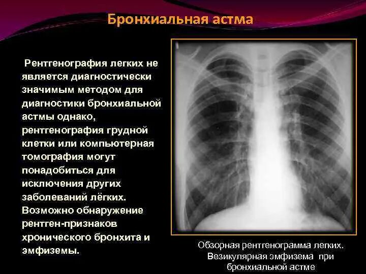 Признаки астмы на рентгене. Рентгенограмма органов грудной клетки при бронхиальной астме. Рентгенограмма грудной клетки при бронхиальной астме. Снимки рентгена легких при астме. После флюорография можно можно кт делать