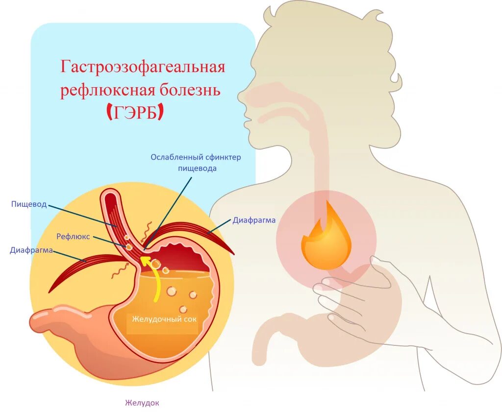 Ленивый желудок симптомы. Гастроэзофагеальная рефлюксная болезнь. Диаграмма с больными ЖКТ.