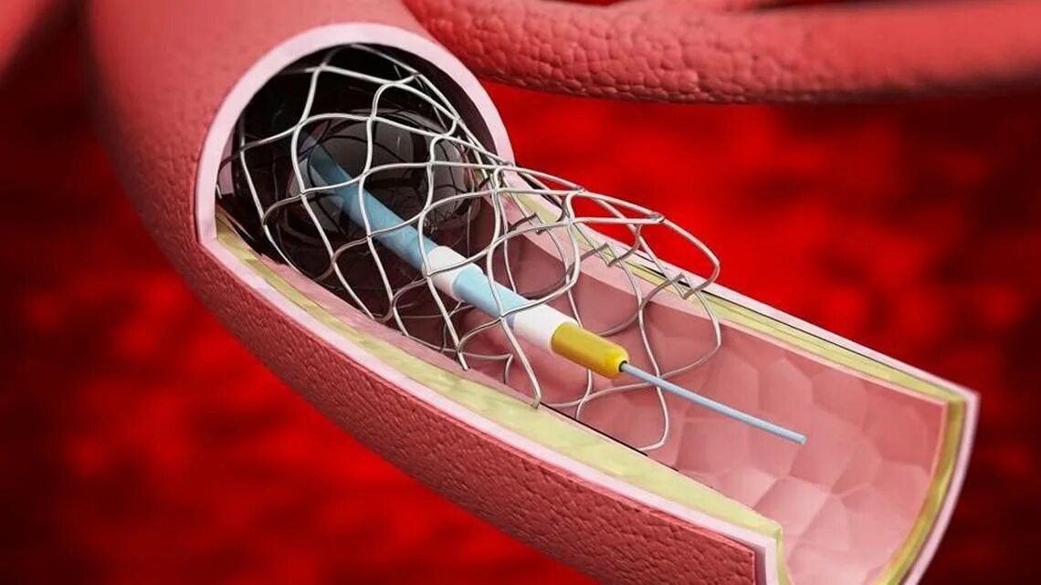 Коронарный стент калипсо. Никелид титана(нитинол). Стент феил. Стент ev3. Стент феил.