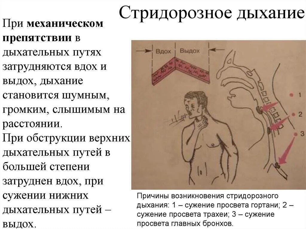 Свист при выдохе в положении лежа причины
