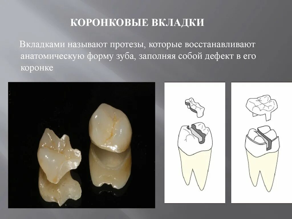 Штифтовая культевая вкладка схема. Коронка вкладка коронка. Металлическая вкладка под коронку.