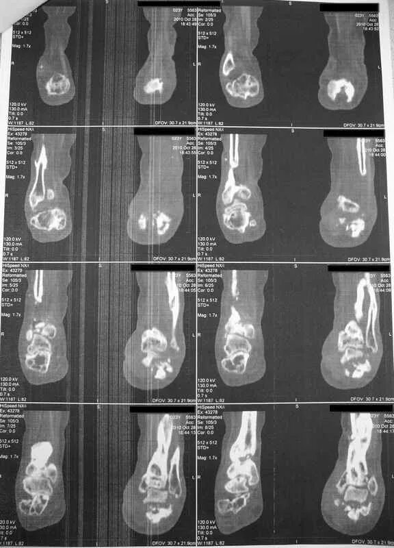 Внутрисуставной перелом пяточной кости рентген. Перелом пяточной кости код по мкб 10. Внутре суставнйи перелом пяточной кости. Перелом пяточной кости код по мкб 10. Импрессионный перелом пяточной кости кт.