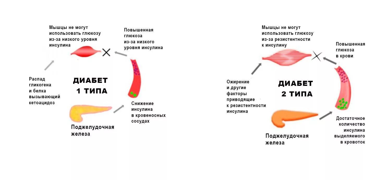 Схема инсулина сахарном диабете 1 типа. Сахарный диабет 1 и 2 типа схема. Факторы риска сахарного диабета 1 и 2 типа таблица. Диабет 2 типа уровень инсулина.