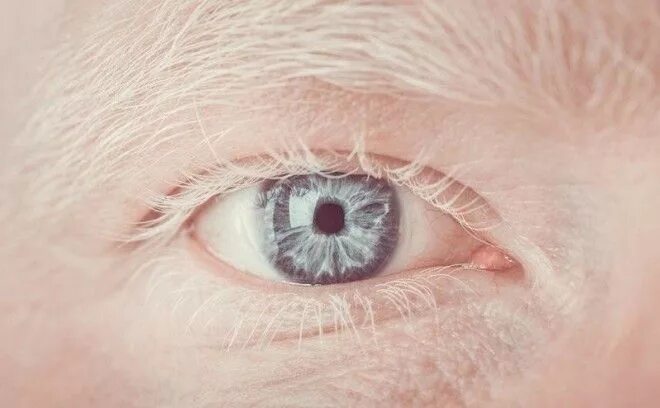 зрение альбиносов. зрение альбиносов. альбинизм радужки глаза. кожно глазной альбинизм. модель альбинос настя жидкова.