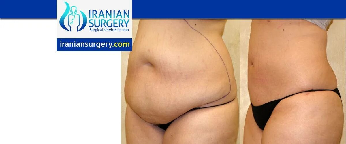 Abdominal liposuction procedure done on female patient using the tumescent lipos