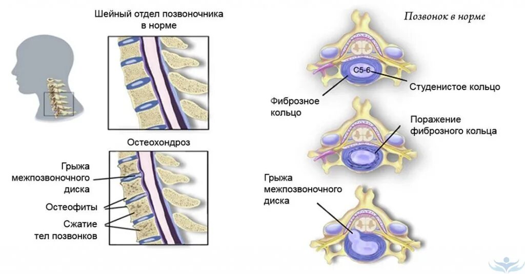 Диффузное выбухание межпозвоночного. Шейный отдел позвоночника шейный отдел позвоночника анатомия. Остеохондроз 1-2 позвонка шейного отдела позвоночника. Грыжа шейного отдела позвоночника. Шейный остеохондроз позвонки шейного отдела.