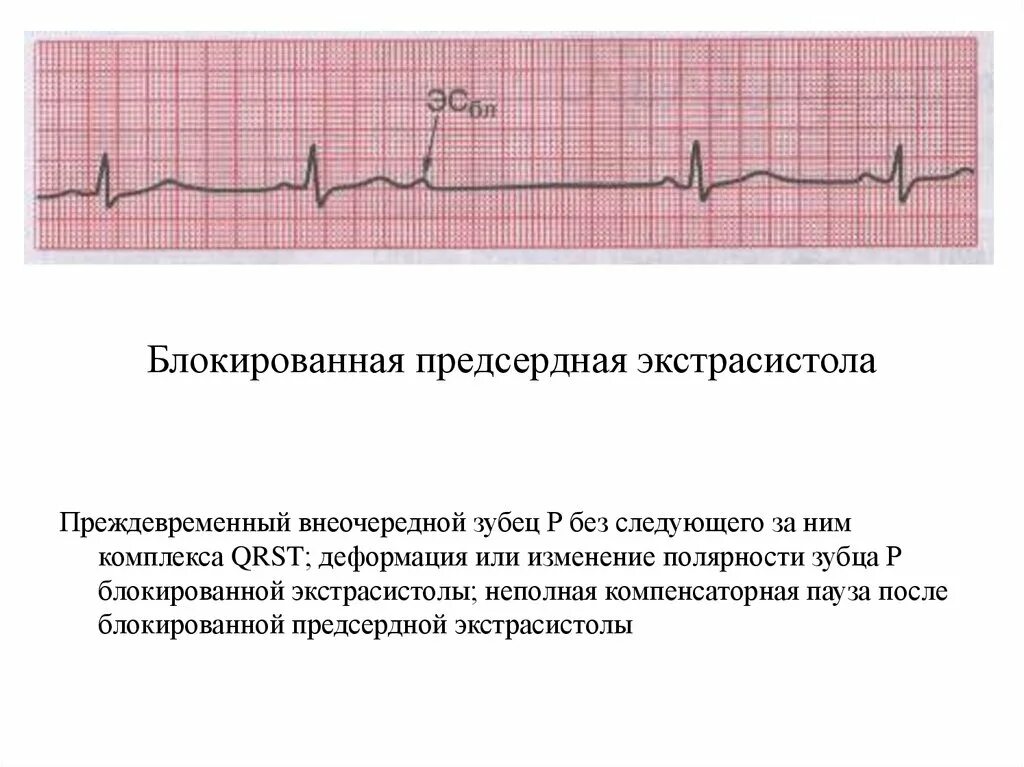 Блокированные предсердные экстрасистолы на ЭКГ. Блокированная желудочковая экстрасистолия на ЭКГ. Блокированная предсердная экстрасистолия на ЭКГ. Блокированная суправентрикулярная экстрасистолия ЭКГ. Блокированные экстрасистолы