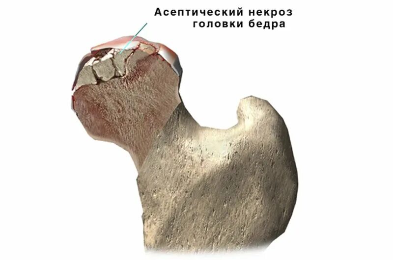 Разрушили голову. Асептик некроз головки бедренной кости. Стадии некроза головки бедренной кости. Степени некроза головки бедренной кости. Асептический некроз коленного кости.