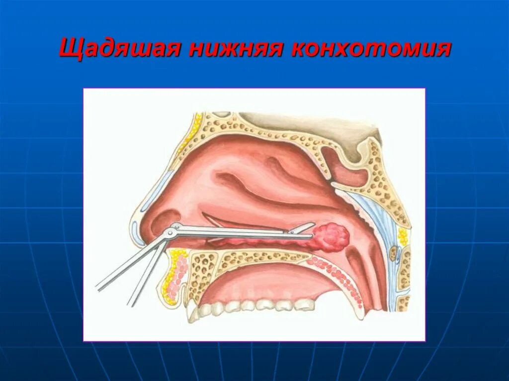 Конхотомия нижних носовых раковин. Хирургическая вазотомия носовых раковин. Гипертрофический ринит. Щадящая конхотомия нижних носовых раковин. Вазотомия носовых раковин операция