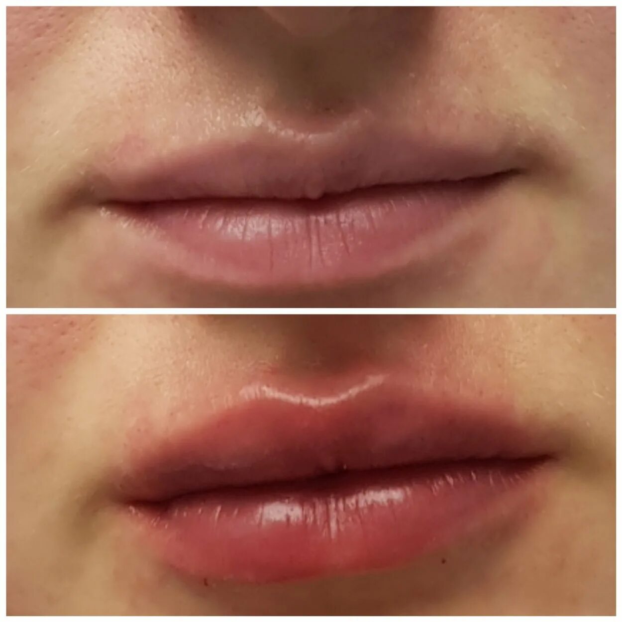 Увлажнение губ. Контурная пластика губ до и после. Контур губ гиалуроновой. Губы после контурной пластики.