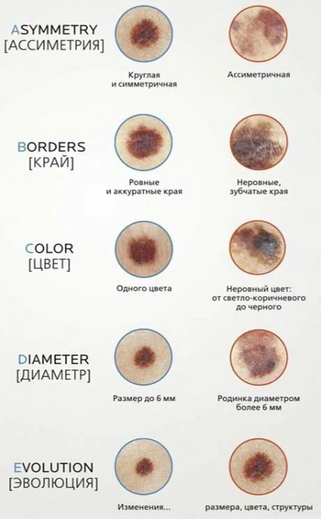 Размер пятна. Лентигинозная меланома. Амеланотическая меланома. Веретеноклеточная меланома.
