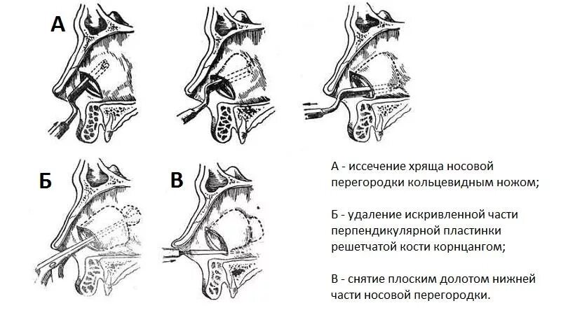 Подслизистая резекция искривленной части перегородки. Искривление носовой перегородки операция схема. Деформация костной части носовой перегородки. Искривление костной части носовой перегородки. Операция по восстановлению перегородки