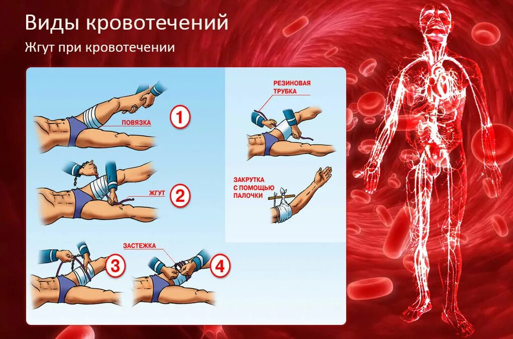Остановка кровотечения артериального венозного и капиллярного. Остановка капиллярного кровотечения. Остановка венозного кровотечения алгоритм. Способы временной остановки венозного капиллярного кровотечения.
