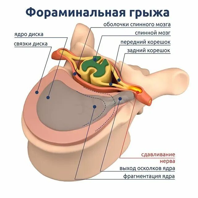 Медианно парамедианная билатеральная. Медианная протрузия межпозвонкового диска с4-с5. Медианная грыжа позвонков диска. Межпозвонковая грыжа парамедианная. Парамедианная экструзия диска.