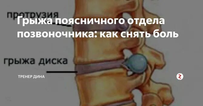 Последствия блокады позвоночника. Грыжа позвоночника. Межпозвонковая грыжа поясничного отдела позвоночника.