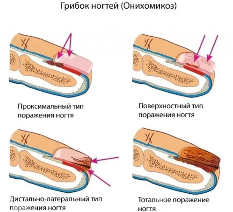Как снять больной ноготь Вросший ноготь (онихокриптоз) все о заболевании простыми словами