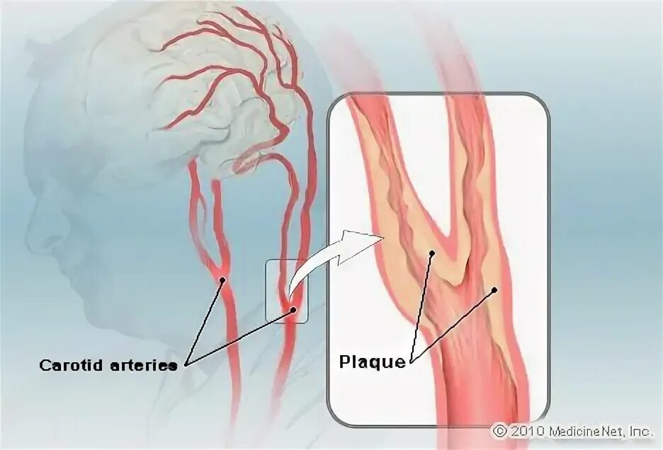 Атеросклероз сосудов сонных артерий. Стеноз каротидной артерии. Атеросклероз брахиоцефальных артерий симптомы. Атеросклероз сонных артерий клиника.