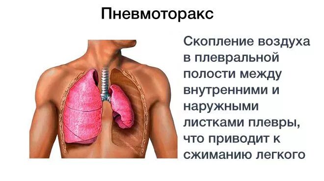 Что если тяжело дышать. Что делать если тяжело дышать. Что делать если человеку тяжело дышать. Причины почему задыхаешься