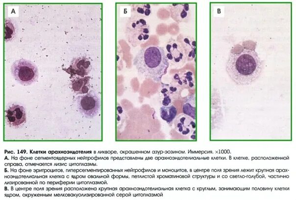 Часть клеток с реактивными изменениями. Цитология ликвора микроскопия. Плевральная жидкость клетки нативный. Исследование спинномозговой жидкости лимфоциты.