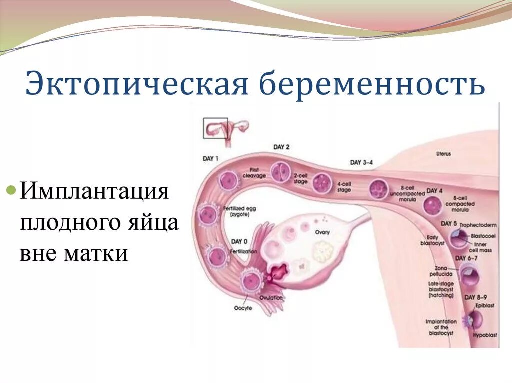 Имплантация плодного яйца в матке. Сроки имплантации плодного яйца в матку. Место прикрепления плодного яйца в матке. При беременности ощущается матка