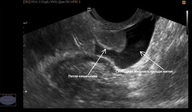 Жидкость в малом тазу на узи. Жидкость в околоселезеночном пространстве на узи. Свободная жидкость в малом тазу на узи. Жидкость при узи малого таза у женщин норма. Жидкость на узи малого таза.
