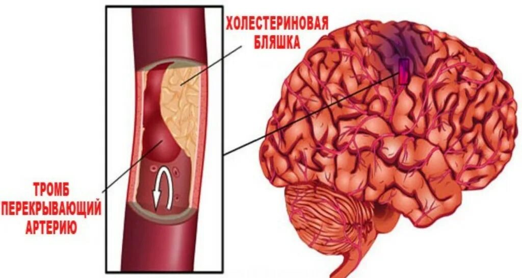 Тромбы после инсульта