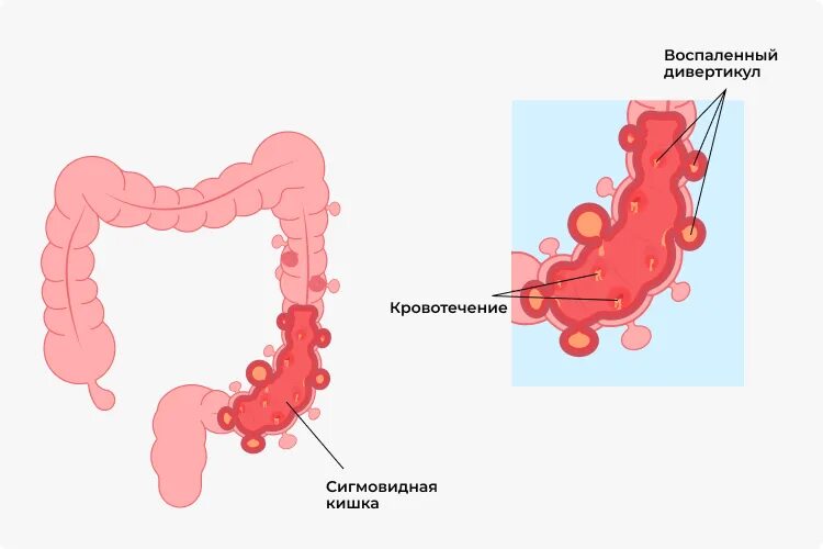 Удлинена сигмовидной. Дивертикулез сигмовидной кишки. Симптомы дивертикулита сигмовидной кишки. Дивертикулит сигмовидной кишки питание. Дивертикулит тонкого кишечника.