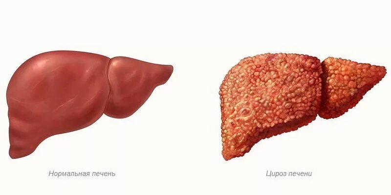 Печень с алкогольным циррозом печени. Алкогольный гепатит и цирроз. Цирроз печени и нормальная печень. Здоровая печень и цирроз печени алкоголика.