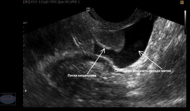 Жидкость в Малом тазу по УЗИ. Свободная жидкость на УЗИ. Свободная жидкость в Малом тазу. Жидкость в подпеченочном пространстве УЗИ.
