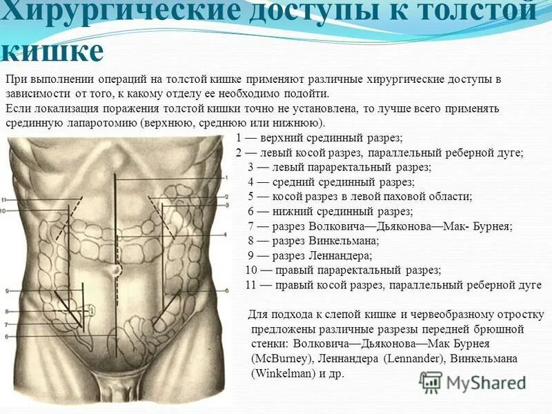 Точка мак бурнея при аппендиците. Точка ланца и мак бурнея. Точка ланца и мак бурнея. Точка ланца и мак бурнея. Разрез мак бурнея волковича дьяконова.