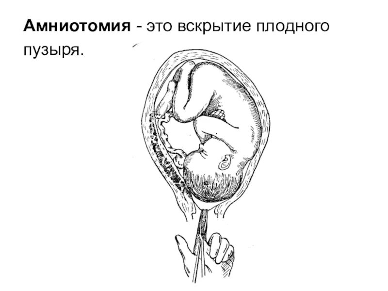 Амниотомия акушерские операции. Операция вскрытия плодного пузыря. Ручное отделение плодных оболочек.