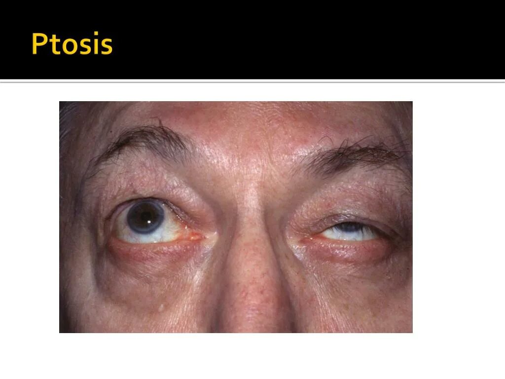 Ptosis латынь. Ptosis латынь