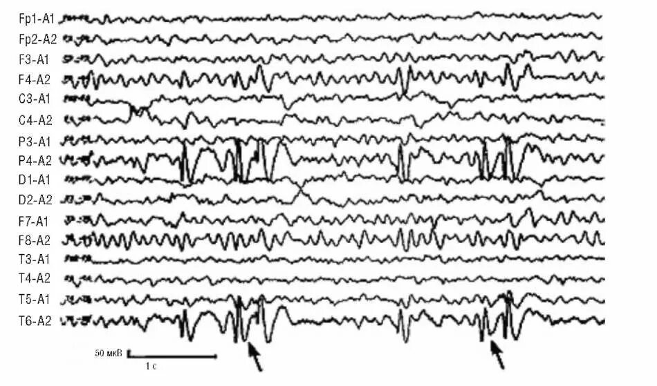 Потенциал ээг. Вертексные потенциалы на ЭЭГ. Вертексные волны на ЭЭГ. Эпилептиформная активность на ЭЭГ. Вертекс потенциалы на ЭЭГ.