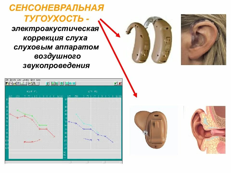 Коррекция нарушения слуха. Сенсоневральная тугоухость слуховой аппарат. Слуховые аппараты для 4 степени тугоухости. Острая и хроническая нейросенсорная тугоухость. Слуховой аппарат нейросенсорная тугоухость.