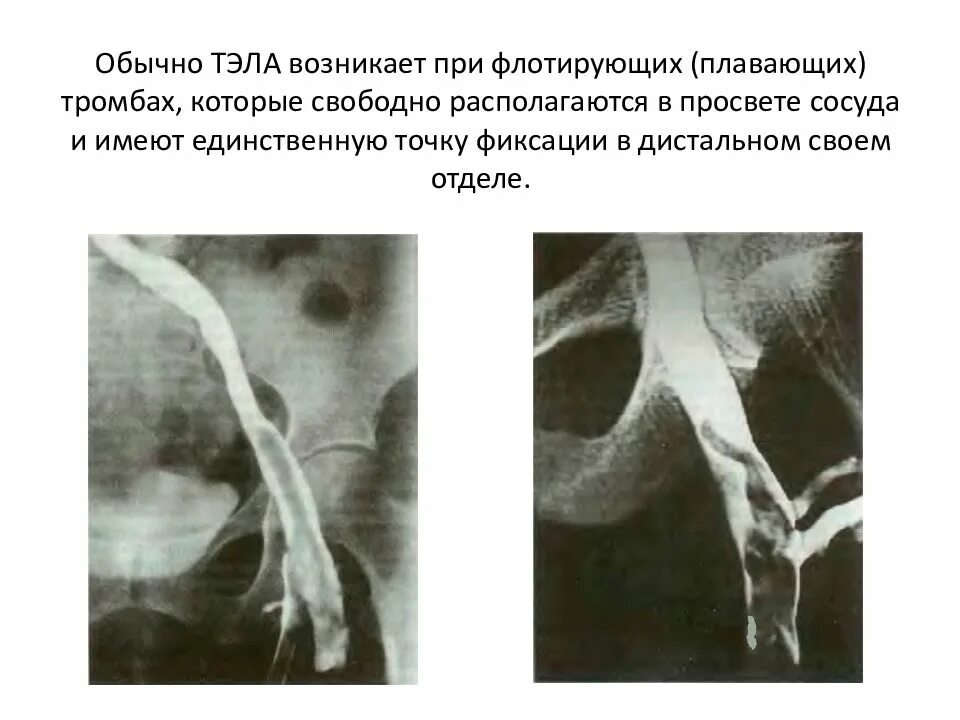 Флотирующий тромб. Флотирующий тромб тэла. флотирующий тромб при тэла.