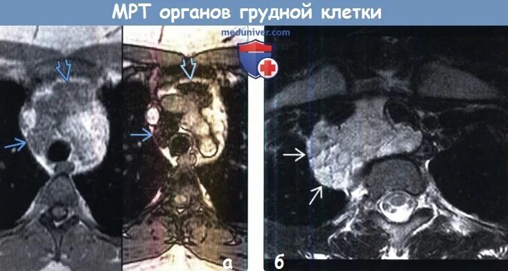 Мрт томография грудной клетки. Мрт грудино реберных сочленений. Мрт мягких тканей грудной клетки. Кт органов грудной. Магнитно-резонансная томография грудной клетки.