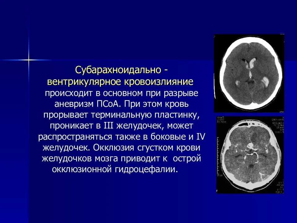 Кровоизлияние в желудочки. Субарахноидальное кровоизлияние мрт. Геморрагический инсульт кт. Инсульт в желудочки головного мозга. Вентрикулярный геморрагический инсульт.