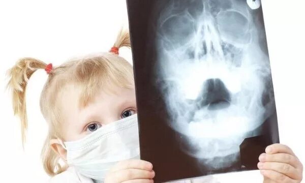 Рентген придаточных пазух носа гайморит. Рентген пазух носа ребенку. Рентгеновский снимок носа ребенка.
