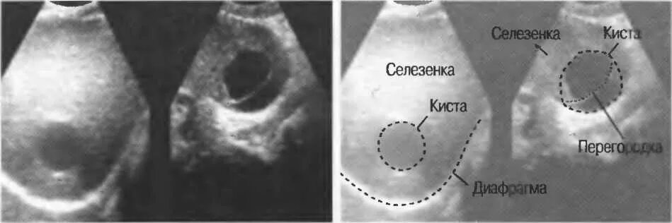 Как отличить кисту. Паразитарная киста селезенки УЗИ. Субкапсулярная киста селезенки. Кистозные образования селезенки на кт. Непаразитарная киста селезенки.