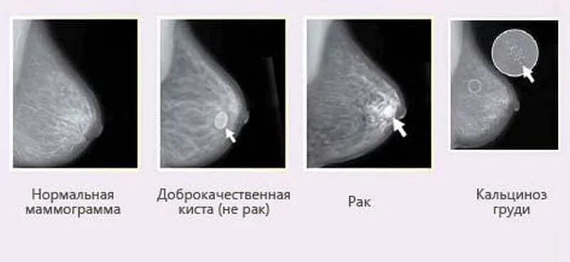 Вторая стадия онкологии: найдено 82 изображений