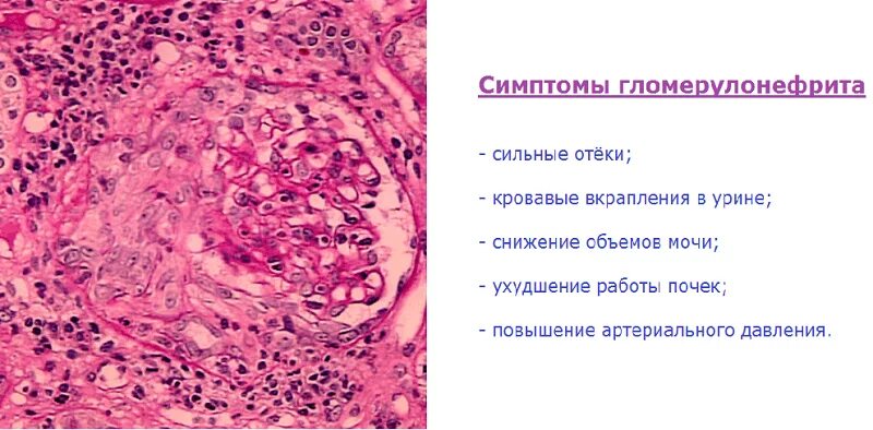 Заболевание почек гломерулонефрит. Экстракапиллярный гломерулонефрит. Экстракапиллярный продуктивный гломерулонефрит. Подострый гломерулонефрит симптомы. Экстракапиллярный гломерулонефрит микропрепарат.