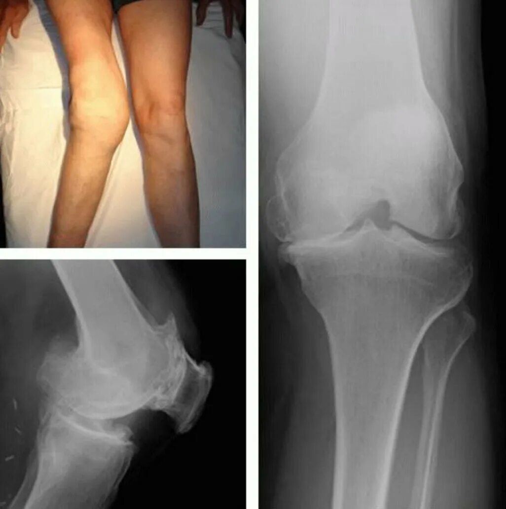 Изменения в коленных суставах. Двусторонний деформирующий гонартроз. Деформирующий гонартроз рентген. Деформирующий гонартроз коленного сустава 2-3 степени. Рентген коленного сустава деформирующий гонартроз.